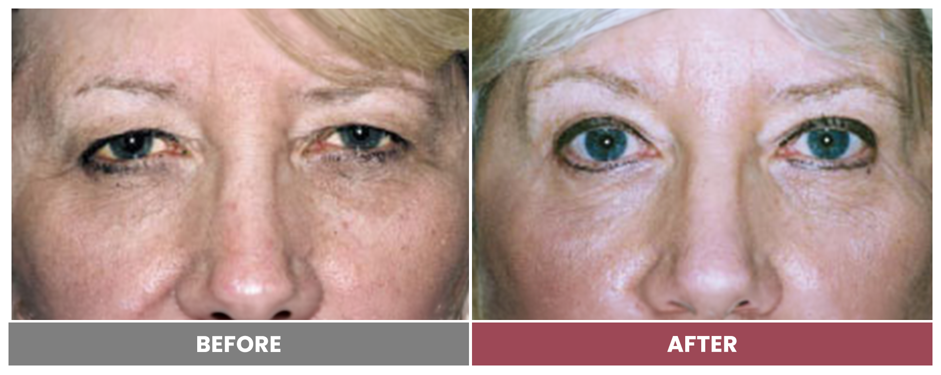 Upper Blepharoplasty - Case 75